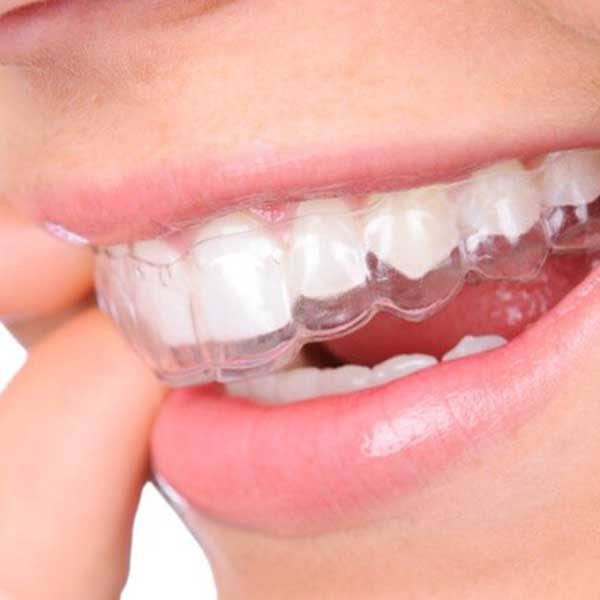 Invisalign Methode - Die durchsichtige Schienentherapie 